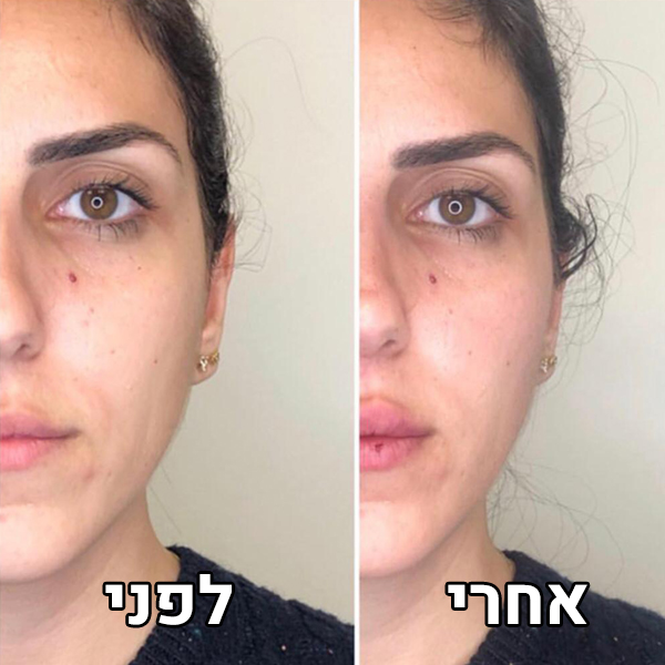 עידון הפנים ועצמות לחיים
