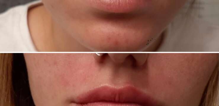 לפני ואחרי עיבוי שפתיים