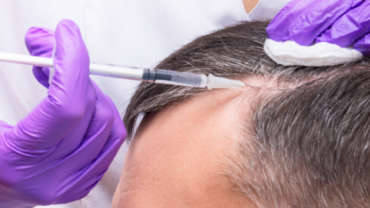 טיפול PRP לחיזוק שורשי השיער לגבר