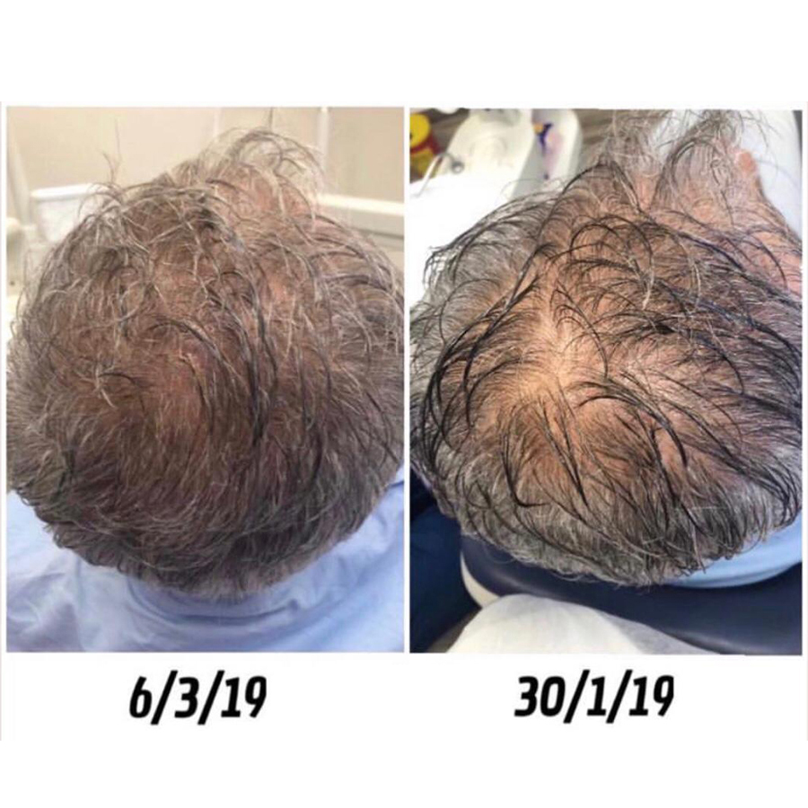 טיפול PRP לחיזוק שורשי השיער לגבר